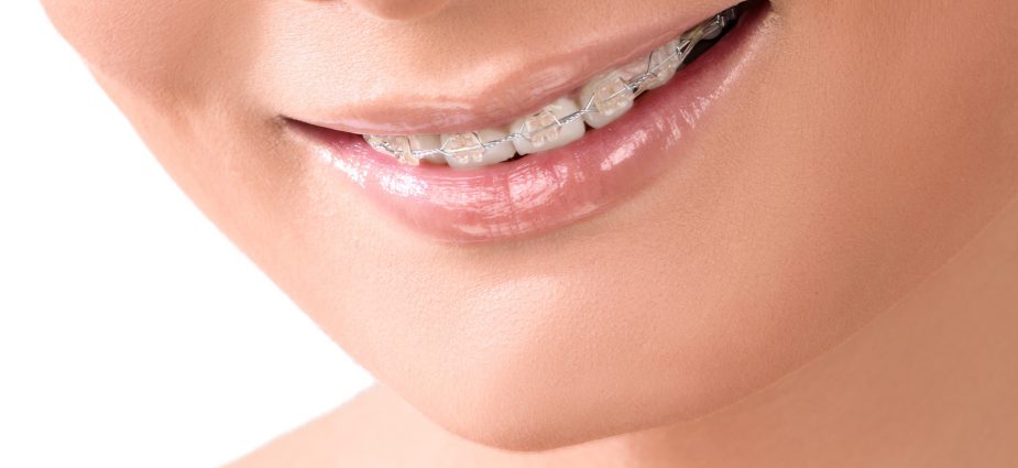Clear Confidence: Discover Invisible Braces in Singapore